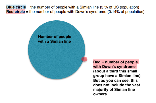 Simian line and downs syndrome