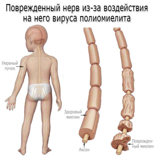 развитие полиомиелита